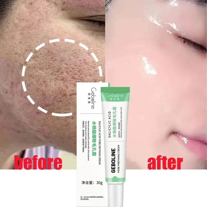 Azelaic Acid Cream - Salicylsäure Poren schrumpfende Creme schnelle Beseitigung