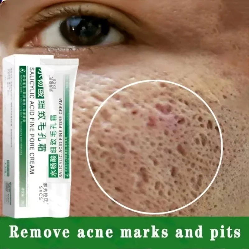 Salicylsäure Poren Clearing Cr – Azelaic Acid Cream Bewertung und Preis