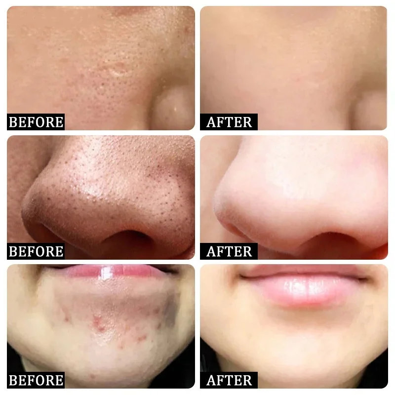 Salicylsäure Poren Clearing Cr – Azelaic Acid Cream Bewertung und Preis