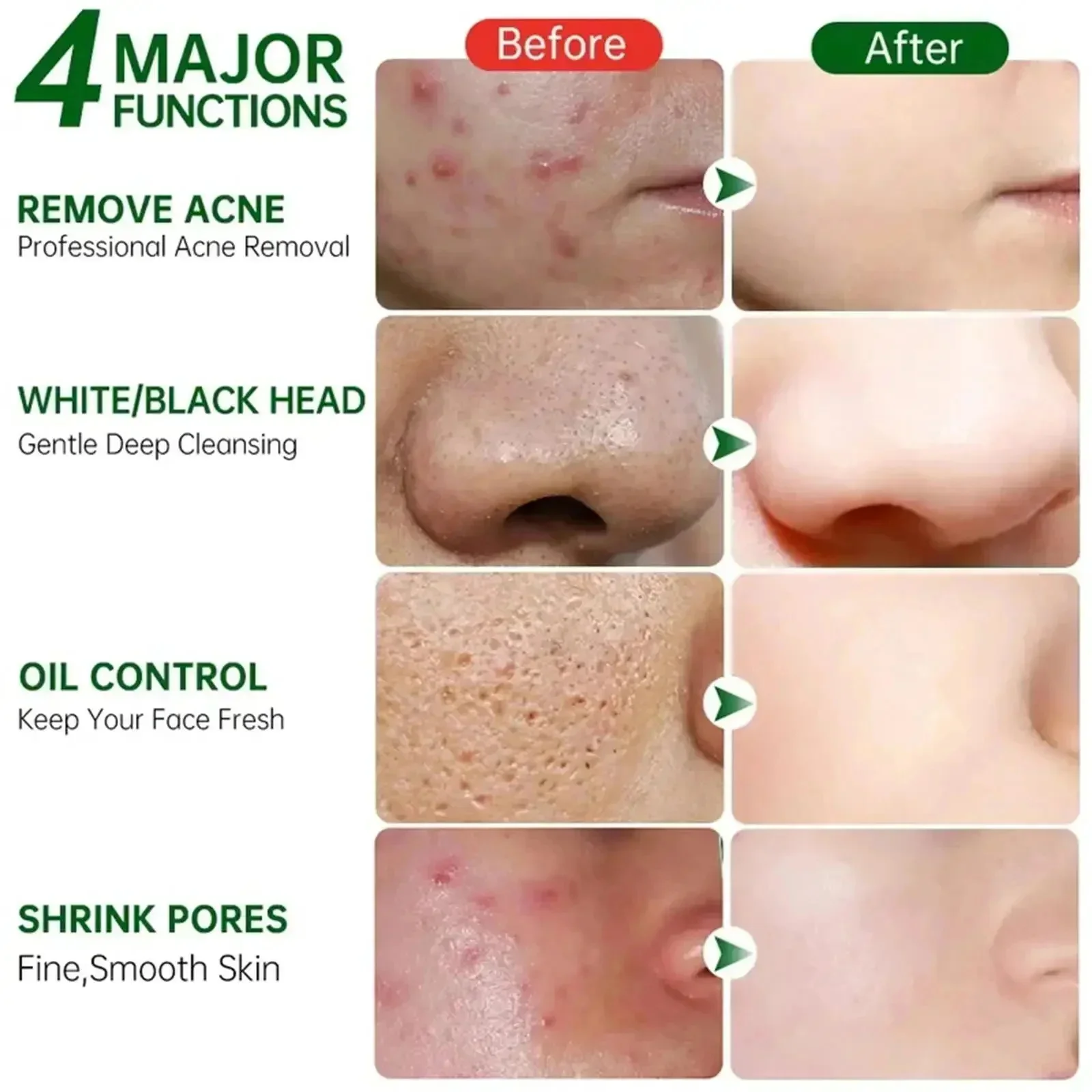 Salicylsäure Poren Clearing Cr – Azelaic Acid Cream Bewertung und Preis